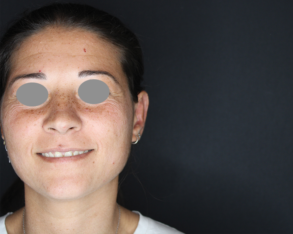 otoplastica-new-post-1a