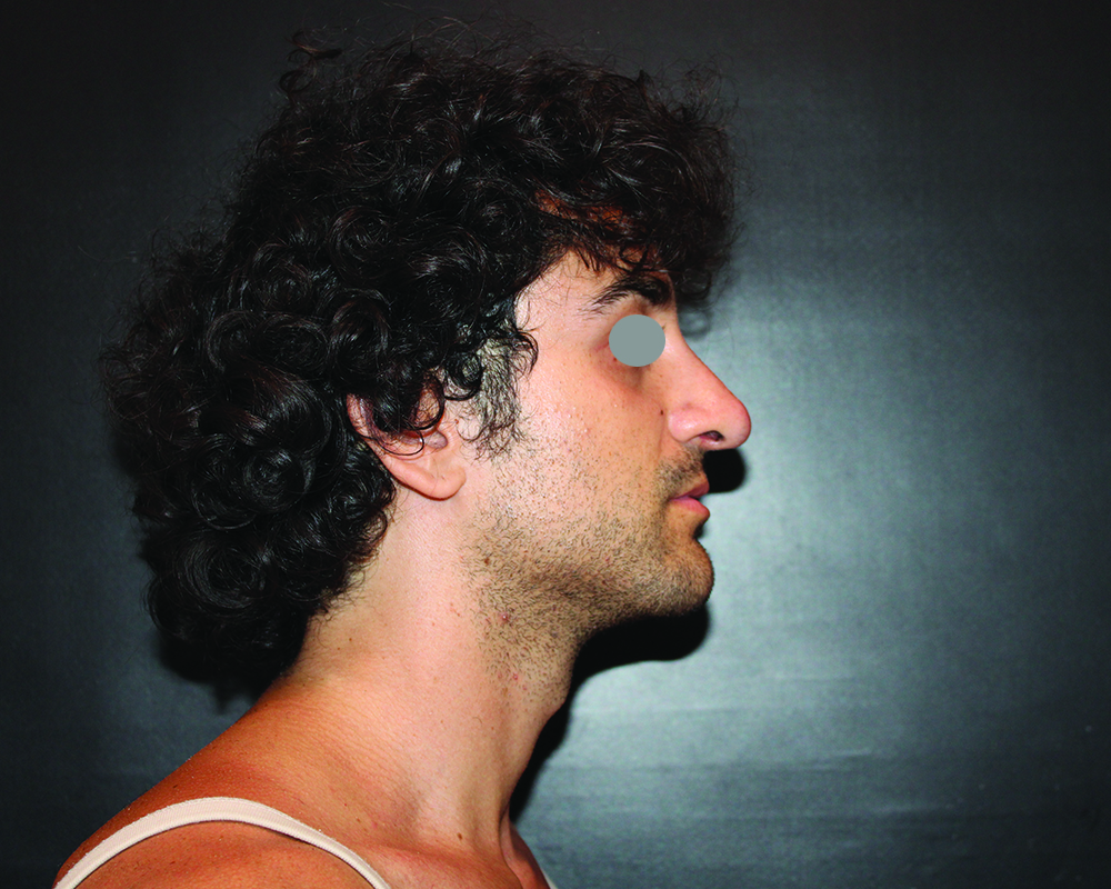 rinoplastica-new-pre-1