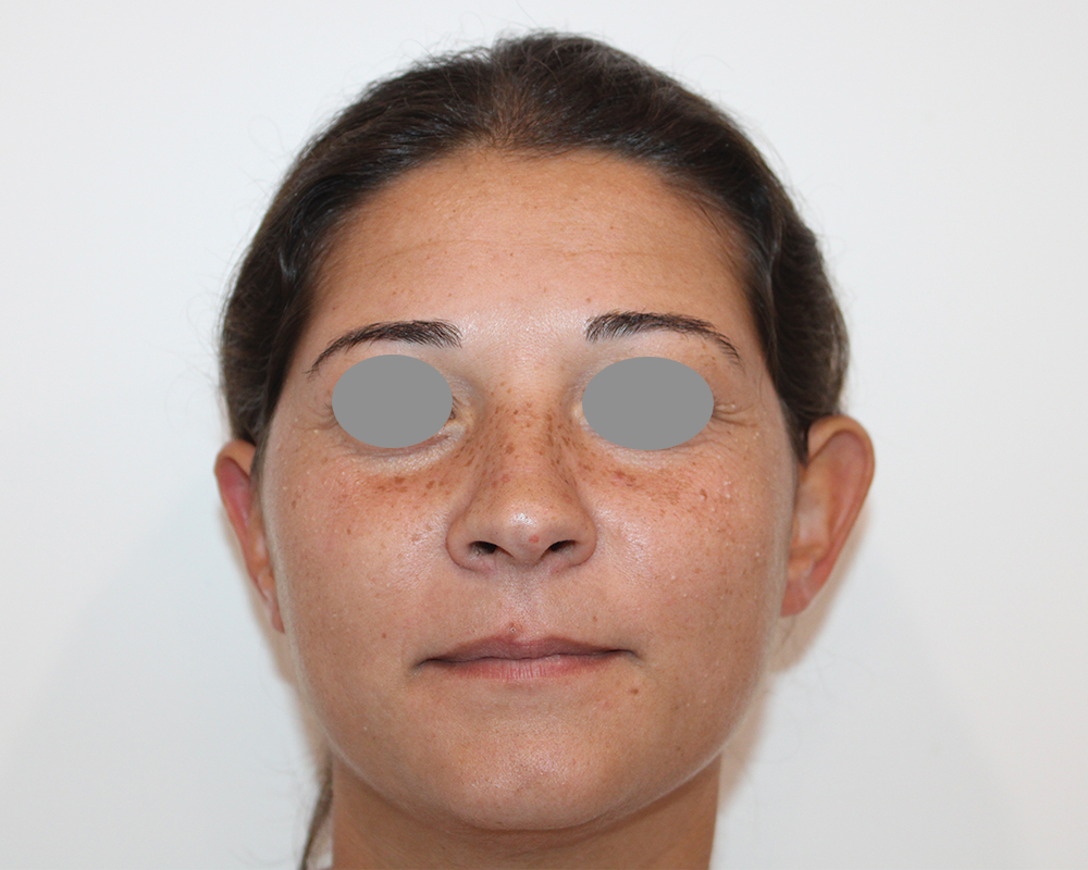 otoplastica-new-pre-1